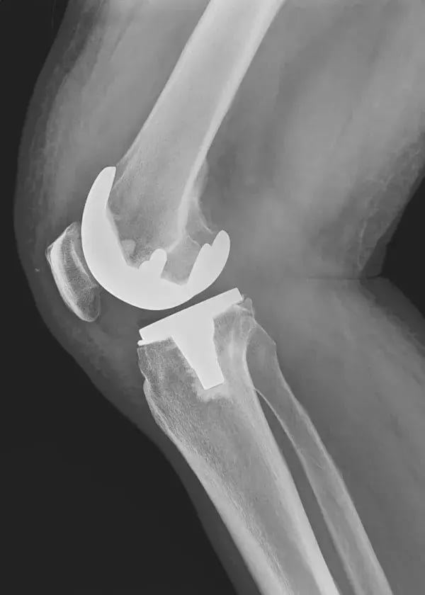 dlyte_sc_003_Knee_Implant_gray-600x0-c-default