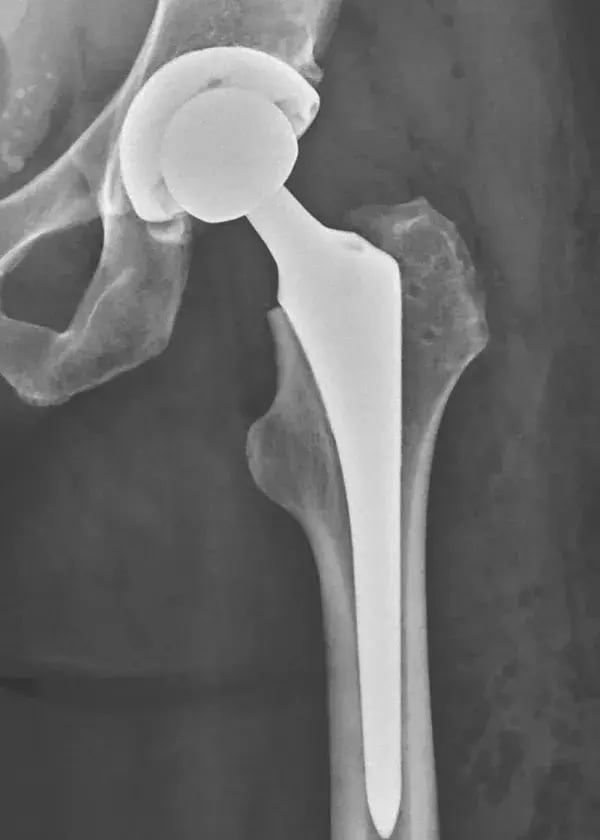 dlyte_sc_008_Hip_Femoral_Stem_gray-600x0-c-default